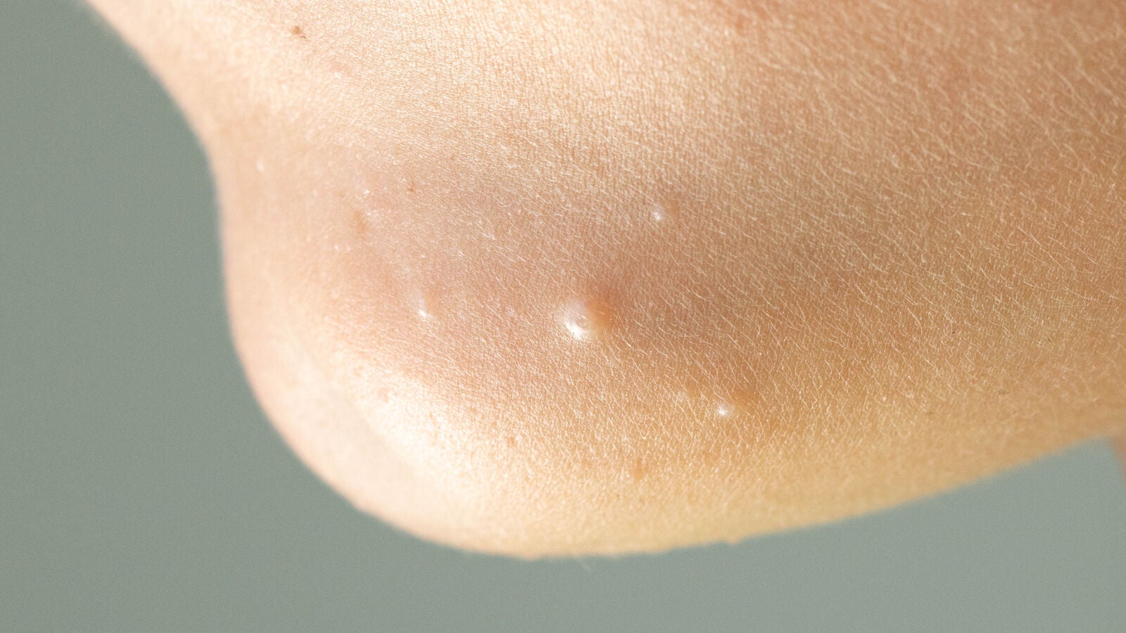 ¿Qué es el molusco contagioso?