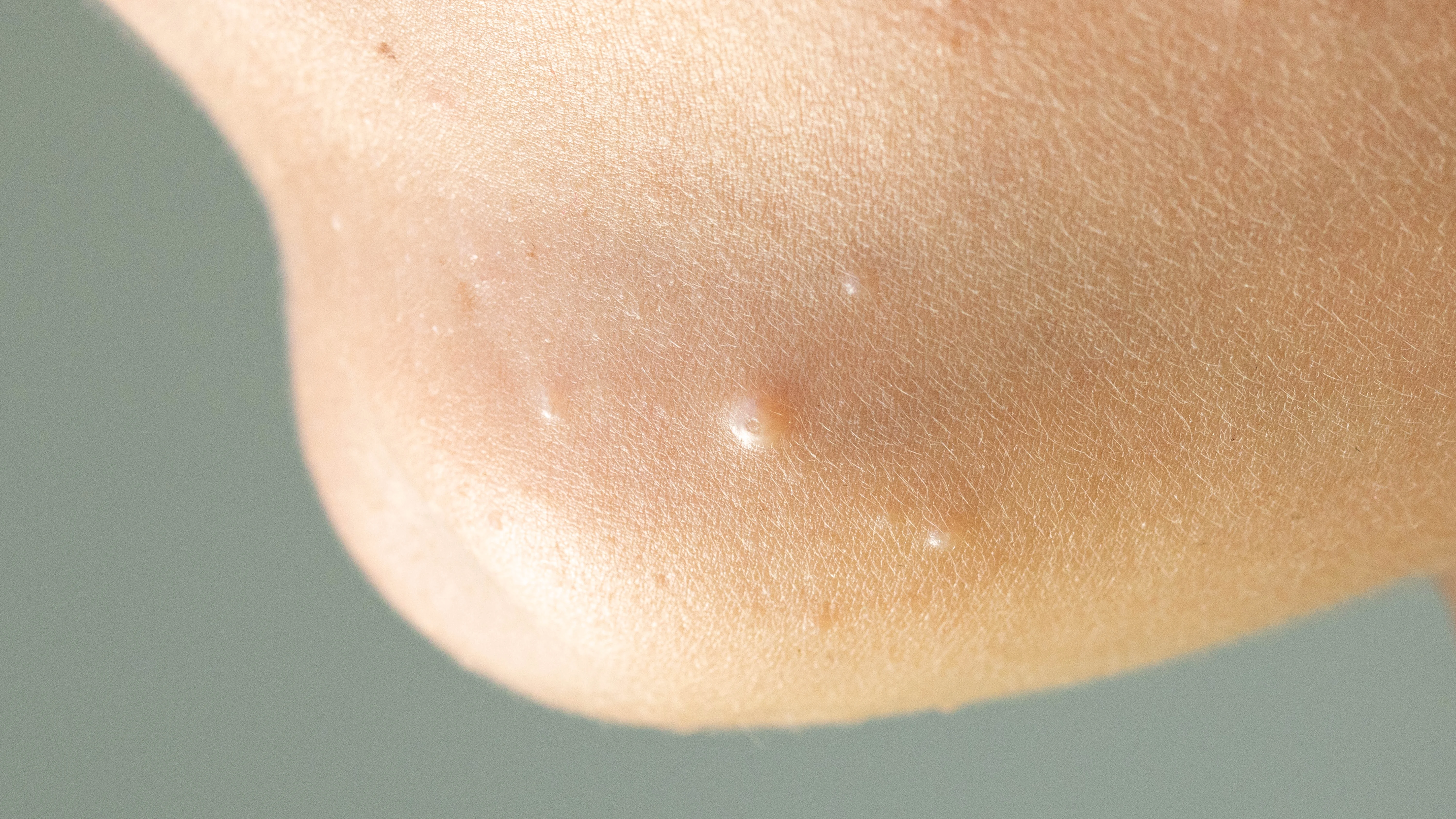 Zona del tobillo con molusco contagioso.