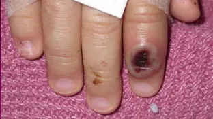 Viruela del mono Viruela del mono