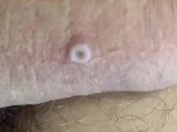 Sarpullido provocado por la viruela del mono Sarpullido provocado por la viruela del mono