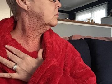 El cuello de la mujer quedó repleto de puntos rojos tras su operación de papada