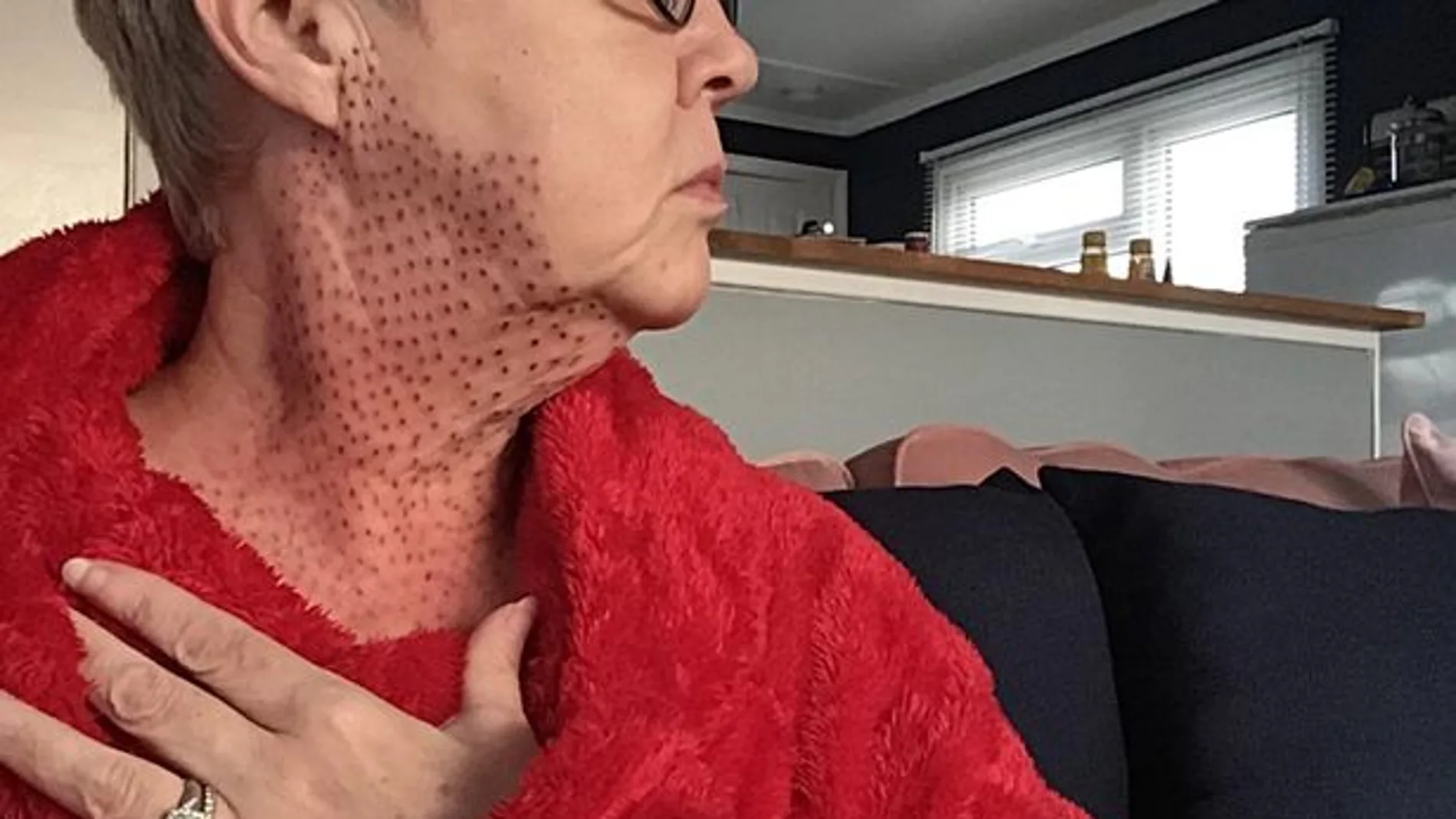 El cuello de la mujer quedó repleto de puntos rojos tras su operación de papada