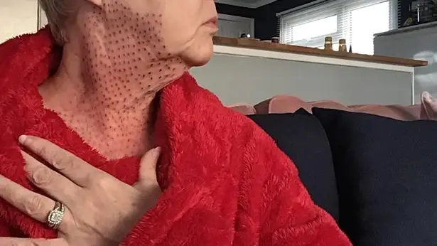 El cuello de la mujer quedó repleto de puntos rojos tras su operación de papada El cuello de la mujer quedó repleto de puntos rojos tras su operación de papada