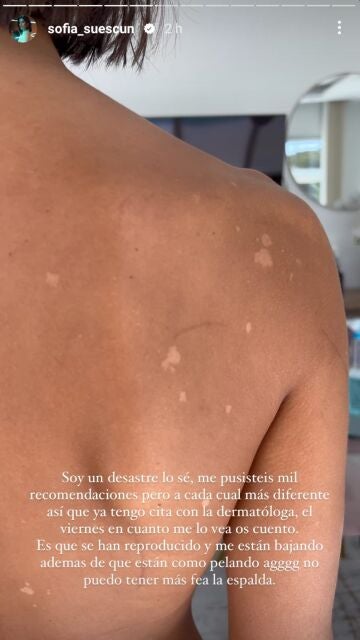 Sofía Suescun enseña las manchas de su espalda