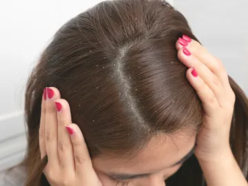 ¿Caspa o Liendres? ¿Caspa o Liendres?