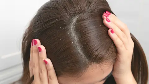 ¿Caspa o Liendres? ¿Caspa o Liendres?