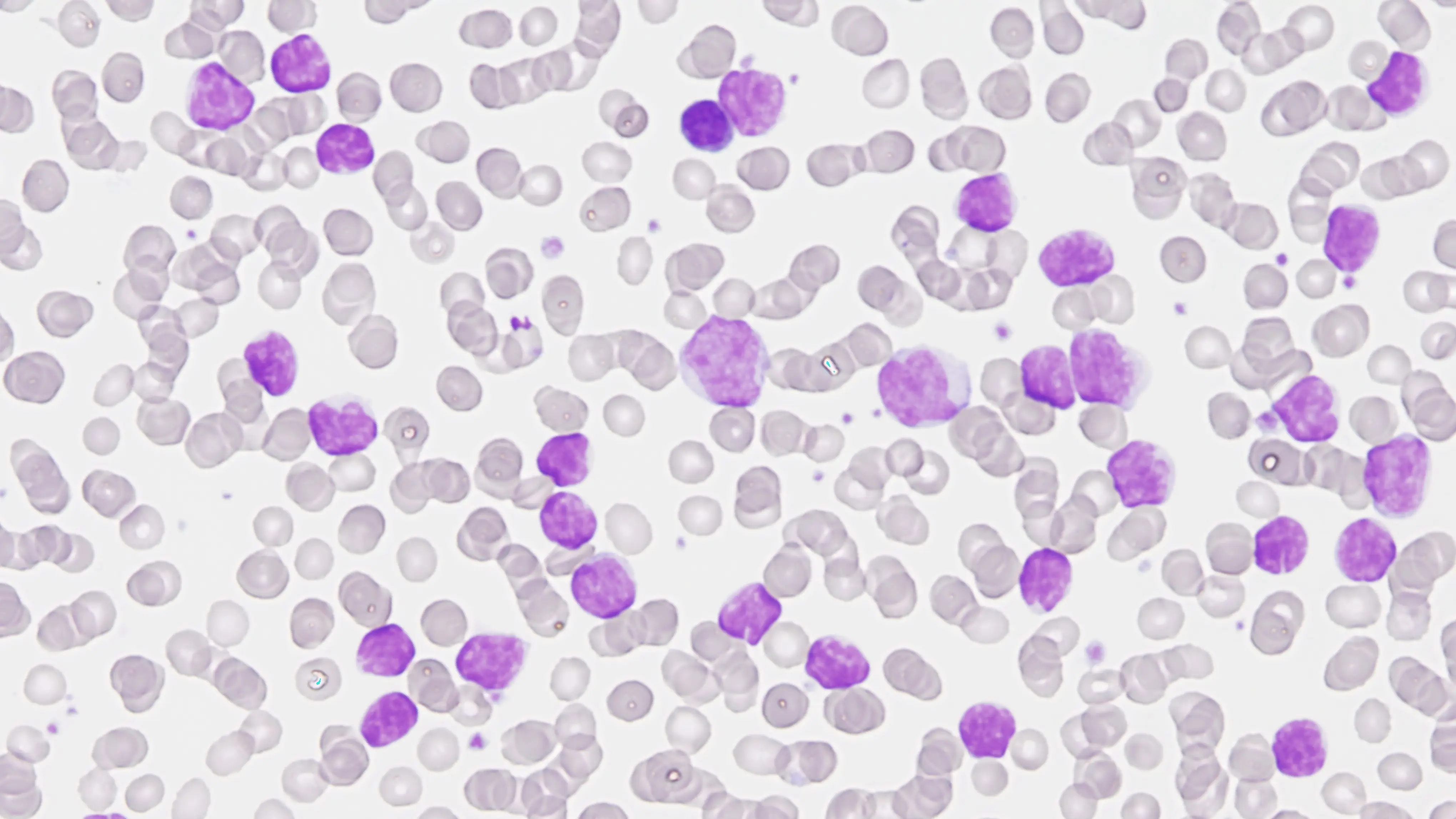 leucemia