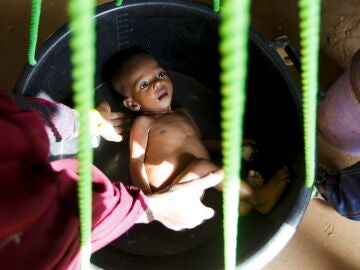 Un bebé desnutrido debido a la gran sequía que sufre Somalia
