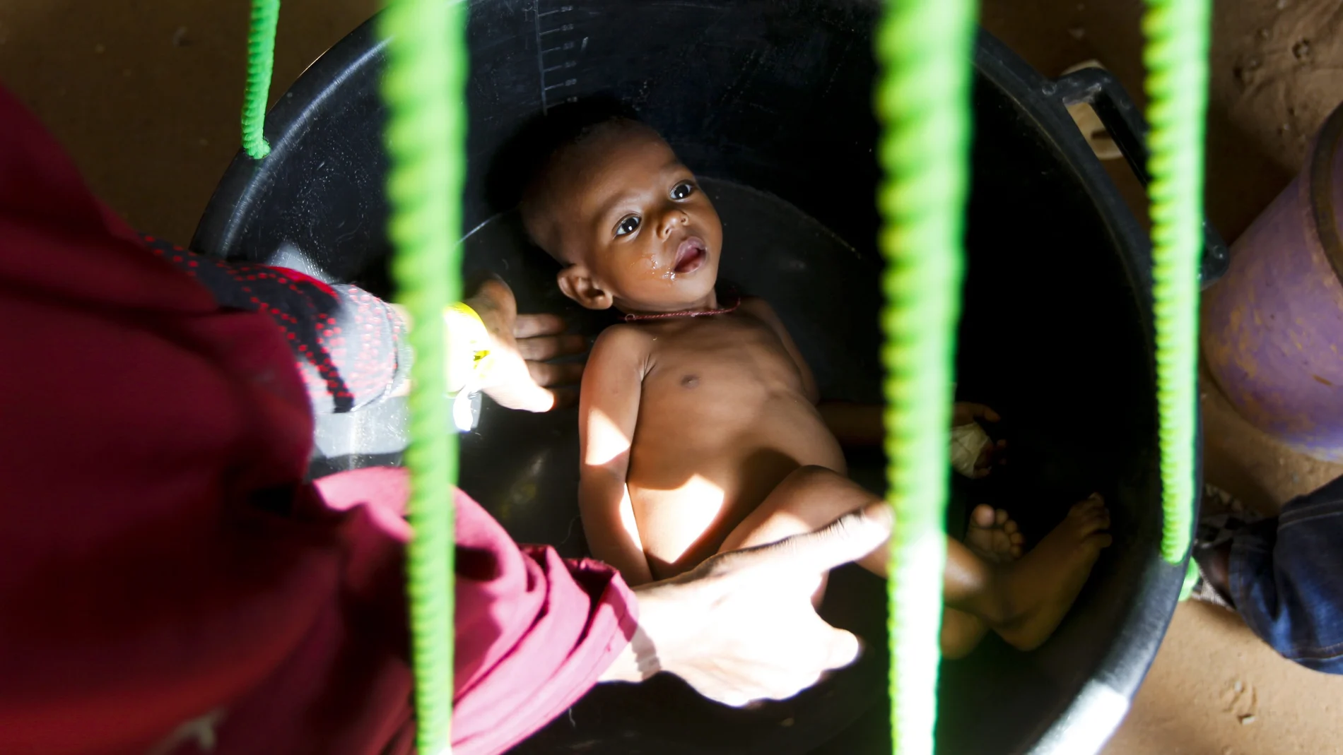Un bebé desnutrido debido a la gran sequía que sufre Somalia