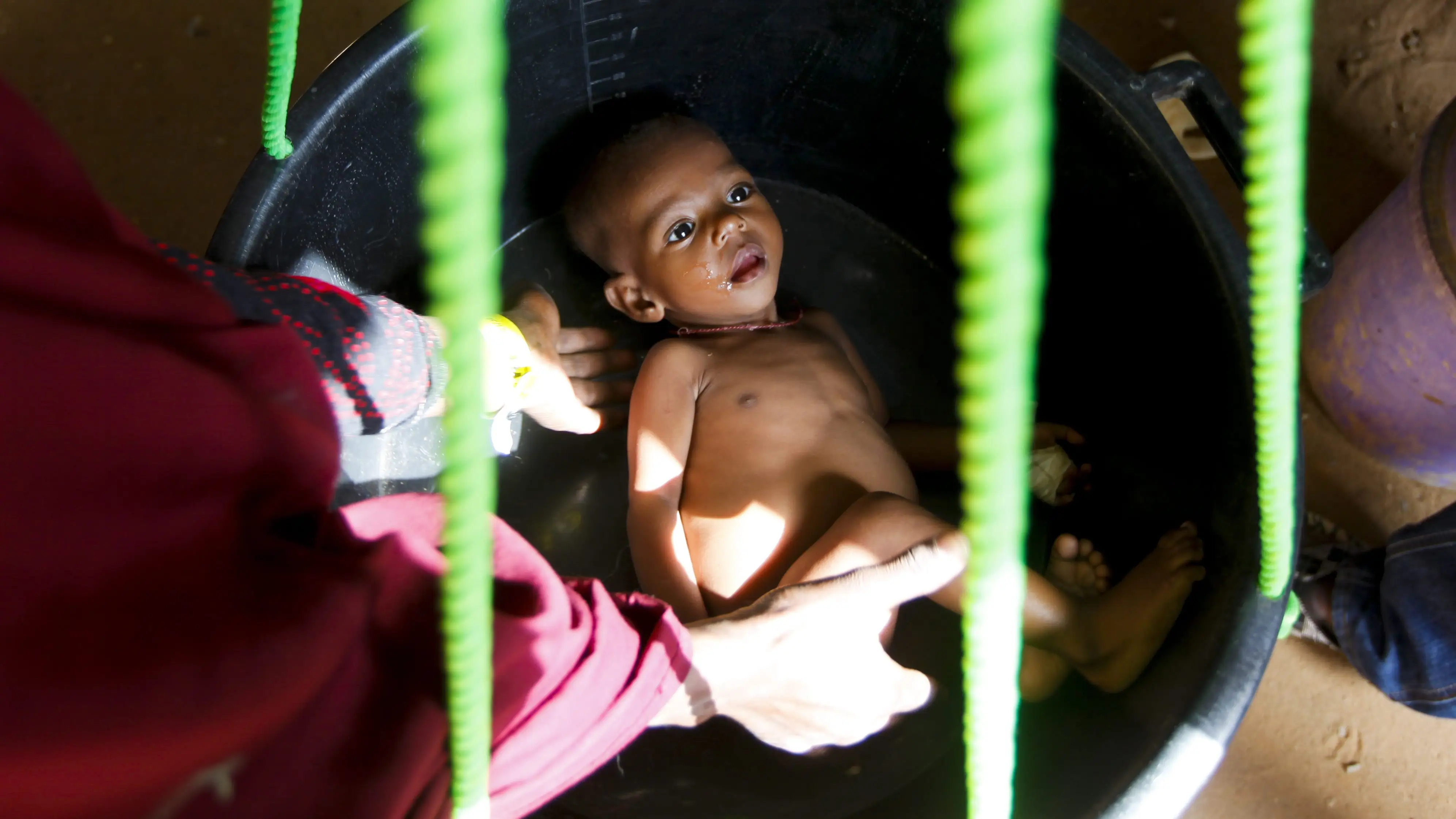 Un beb&eacute; desnutrido debido a la gran sequ&iacute;a que sufre Somalia