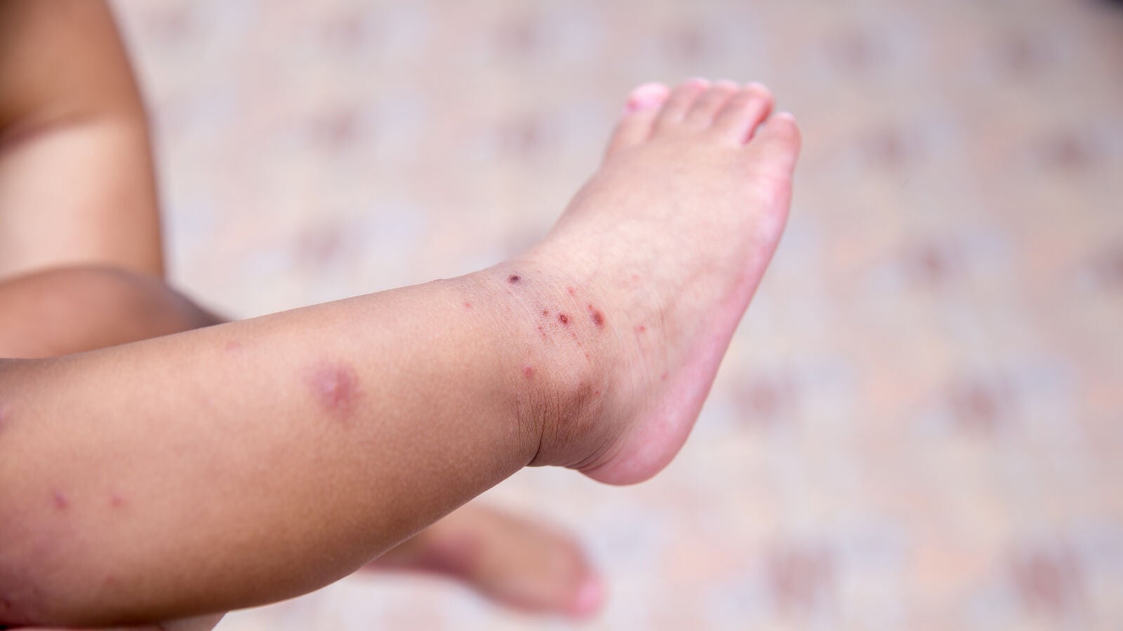 Boca-mano-pie: Qué es y cómo se contagia este virus tan frecuente en la infancia