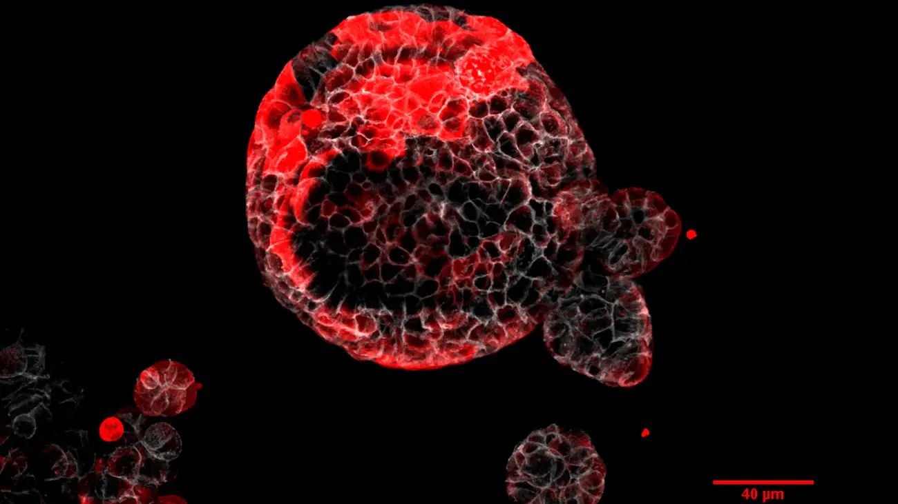 Organoide de cáncer colorrectal con células residuales responsables de la recaída Organoide de cáncer colorrectal con células residuales responsables de la recaída