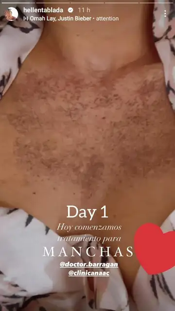 Elena Tablada muestra su escote tras el tratamiento para manchas Elena Tablada muestra su escote tras el tratamiento para manchas
