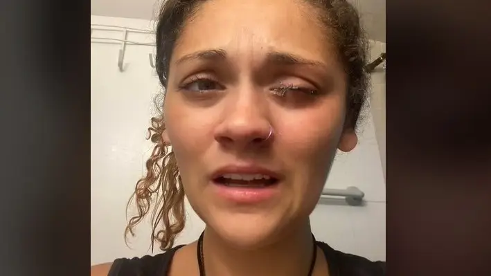 Confunde el bote de gotas para los ojos con super pegamento Confunde el bote de gotas para los ojos con super pegamento