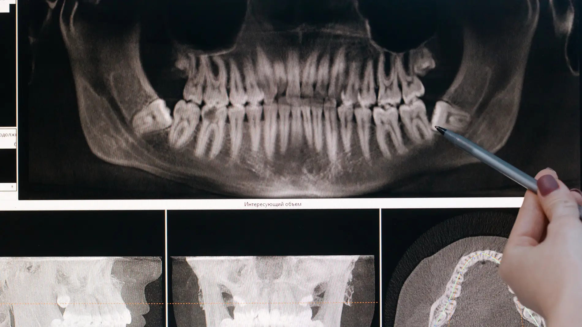 Radiografía maxilofacial