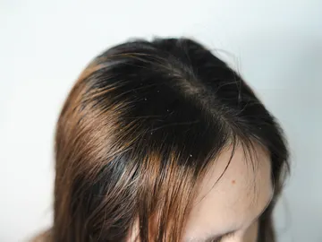 Pelo graso Pelo graso