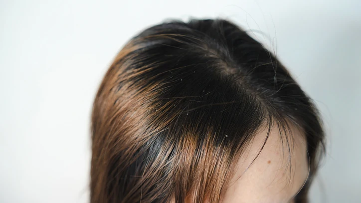 Pelo graso