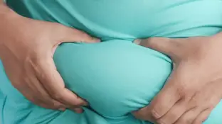 Obesidad Obesidad