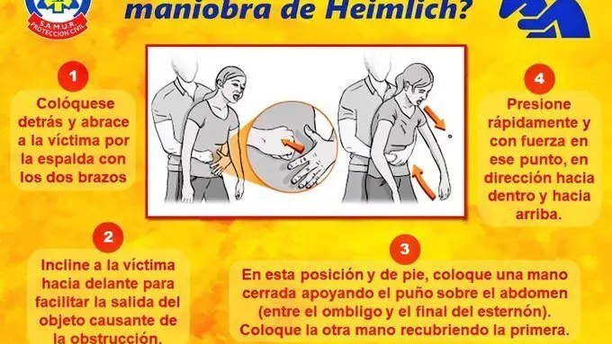 Pasos correctos para una buena maniobra de Heimlich Pasos correctos para una buena maniobra de Heimlich
