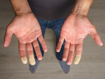 Manos con síndrome de Raynaud Manos con síndrome de Raynaud