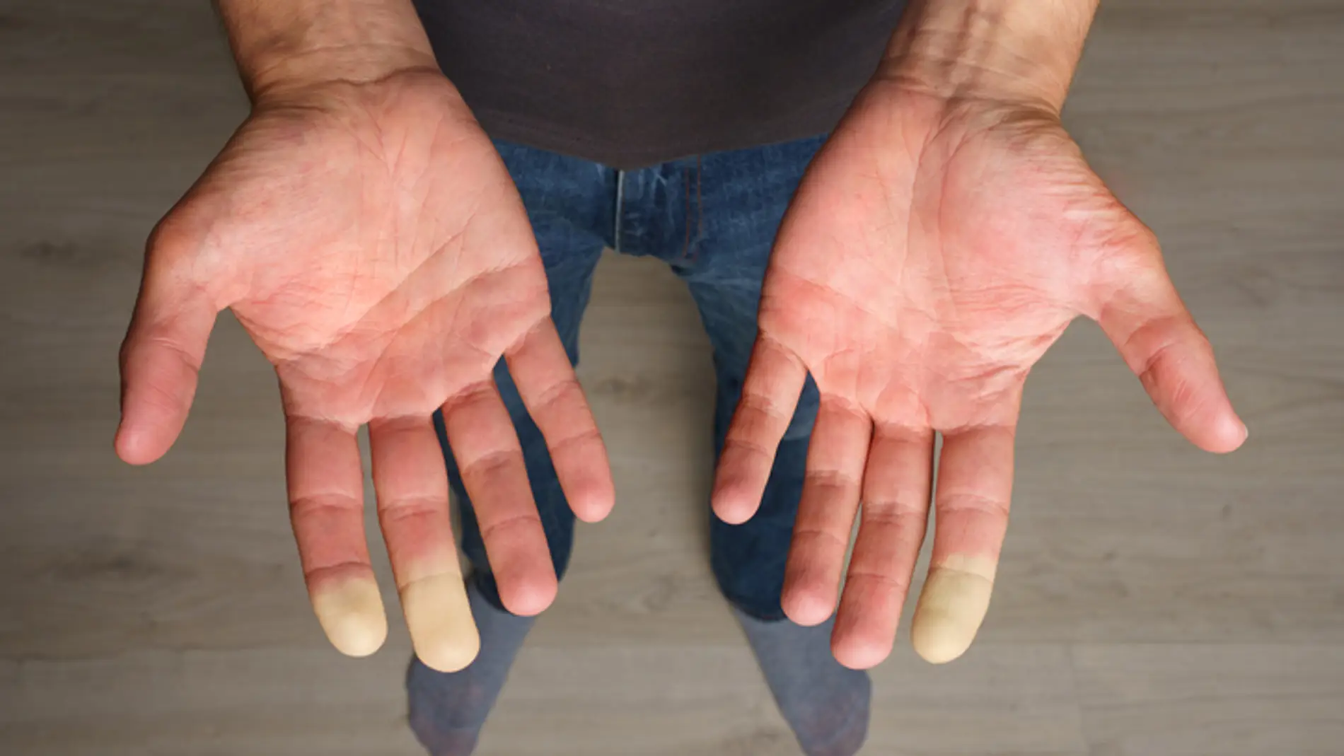 Manos con síndrome de Raynaud