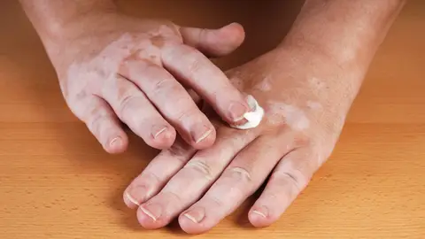 Hipopigmentación en la mano Hipopigmentación en la mano