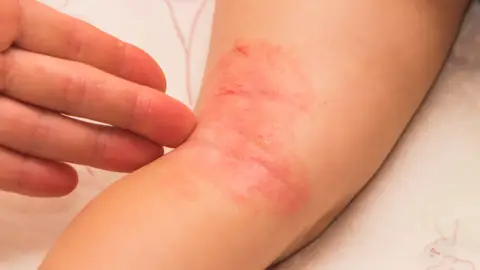 Infección por hongos Infección por hongos