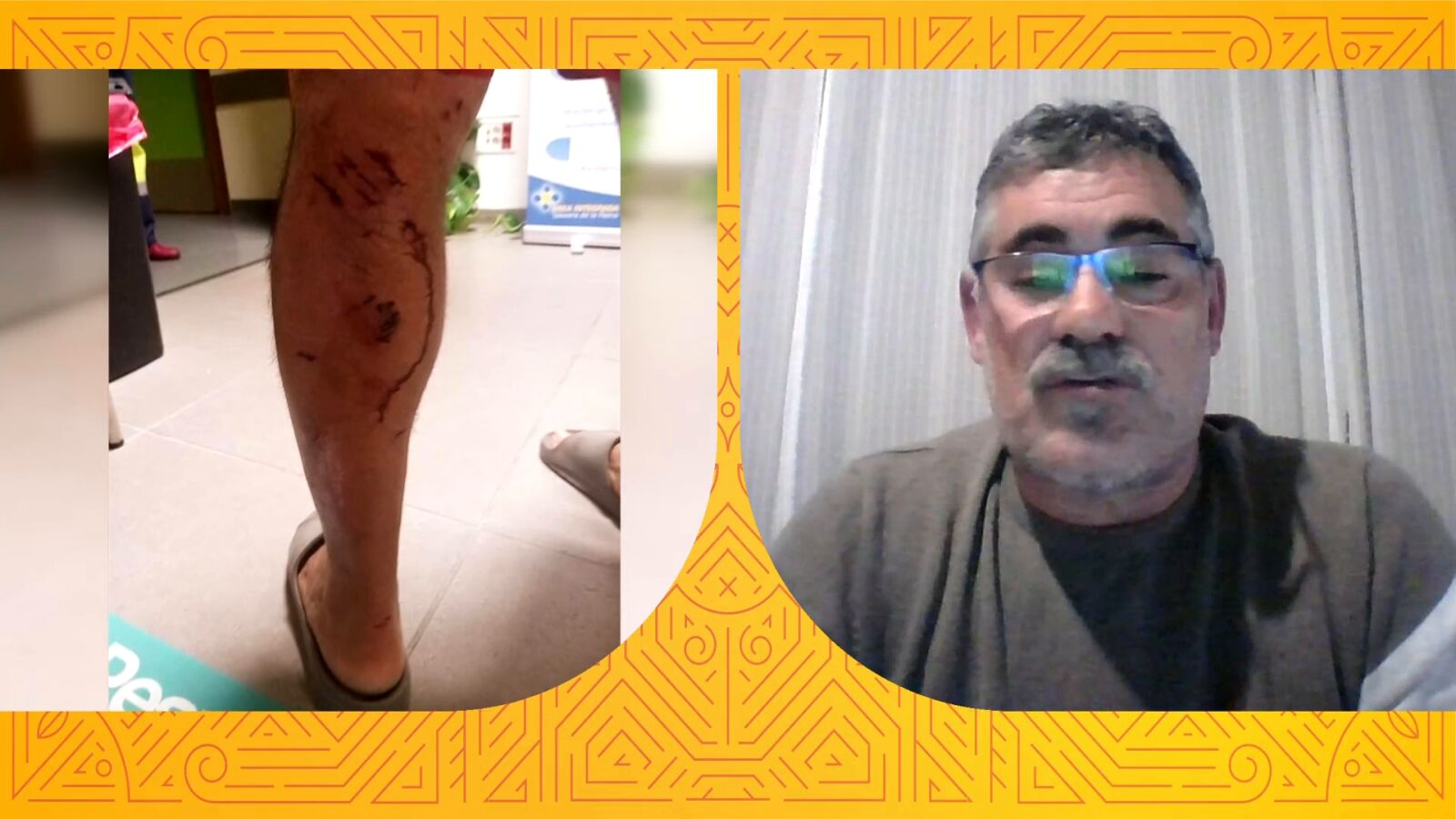 Félix Dasilva, atacado por cinco perros que le destrozaron los gemelos: 