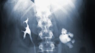 Tuberculosis