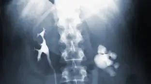 Tuberculosis Tuberculosis