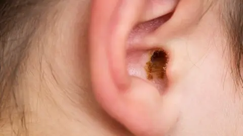 Cera en los oídos Cera en los oídos