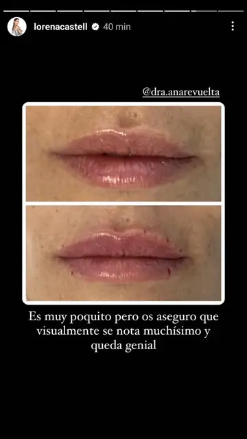 Resultado retoque estético Lorena Castell Resultado retoque estético Lorena Castell