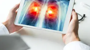 Cáncer de pulmón Cáncer de pulmón