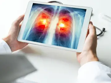 Cáncer de pulmón Cáncer de pulmón
