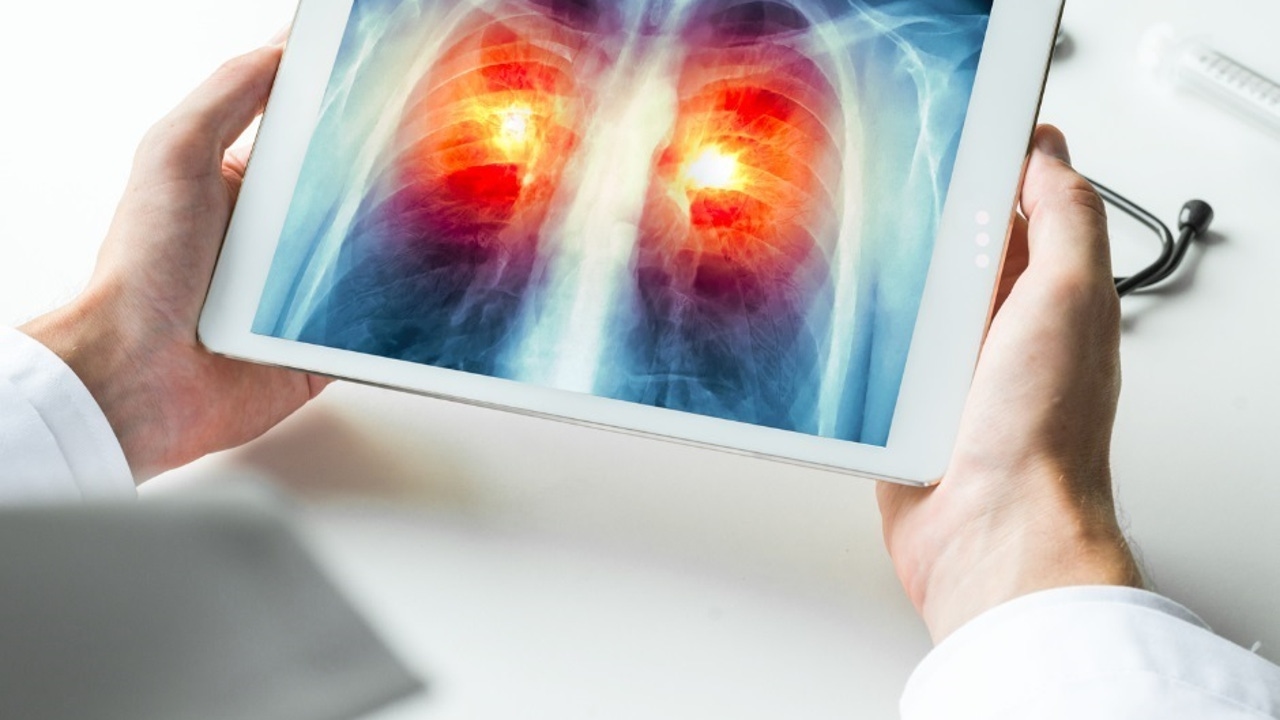 Les études sur la vaccination contre le cancer du poumon fournissent des résultats encourageants