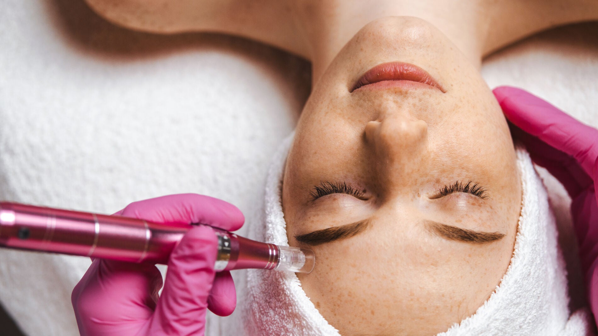 ¿Qué es la mesoterapia y para quién está indicada?