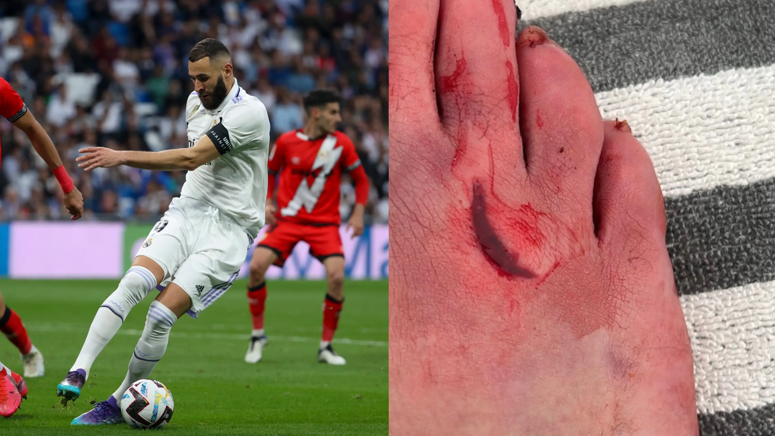 Karim Benzema, ante el Rayo Vallecano y una segunda imagen del corte en su pie derecho Karim Benzema, ante el Rayo Vallecano y una segunda imagen del corte en su pie derecho