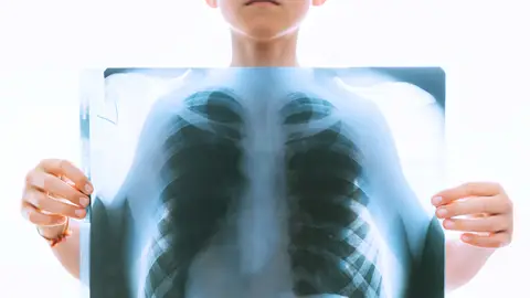 Un nuño sujeta una radiografía de torax Un nuño sujeta una radiografía de torax