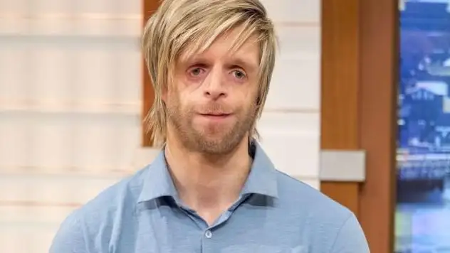Jono Lancaster, que sufre el s&iacute;ndrome de Treacher Collins