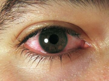 Imagen de archivo de un ojo con conjuntivitis
