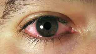 Imagen de archivo de un ojo con conjuntivitis