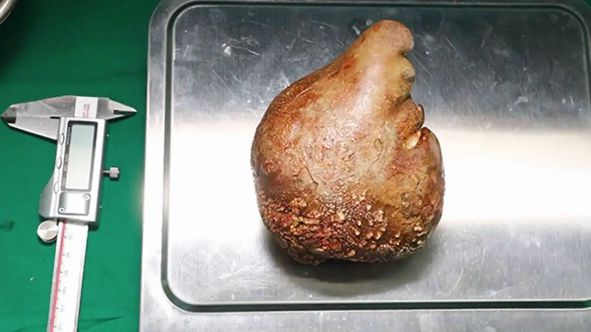 C&aacute;lculo renal 