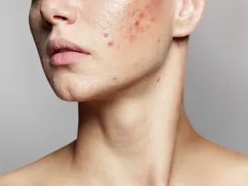 Acné Acné