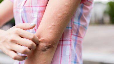 Picaduras de mosquito y de araña: ¿Cómo diferenciarlas?