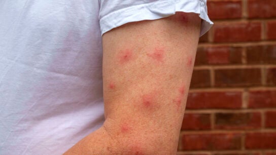 Picaduras de mosquito