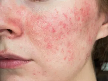 Rosacea Rosacea