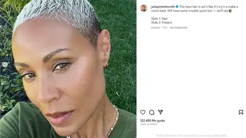 Jada Pinkett Smith mostrando su progreso con la alopecia Jada Pinkett Smith mostrando su progreso con la alopecia