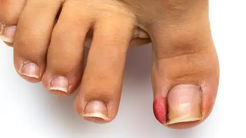 Uñas encarnadas Uñas encarnadas