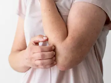 Dermatitis Dermatitis