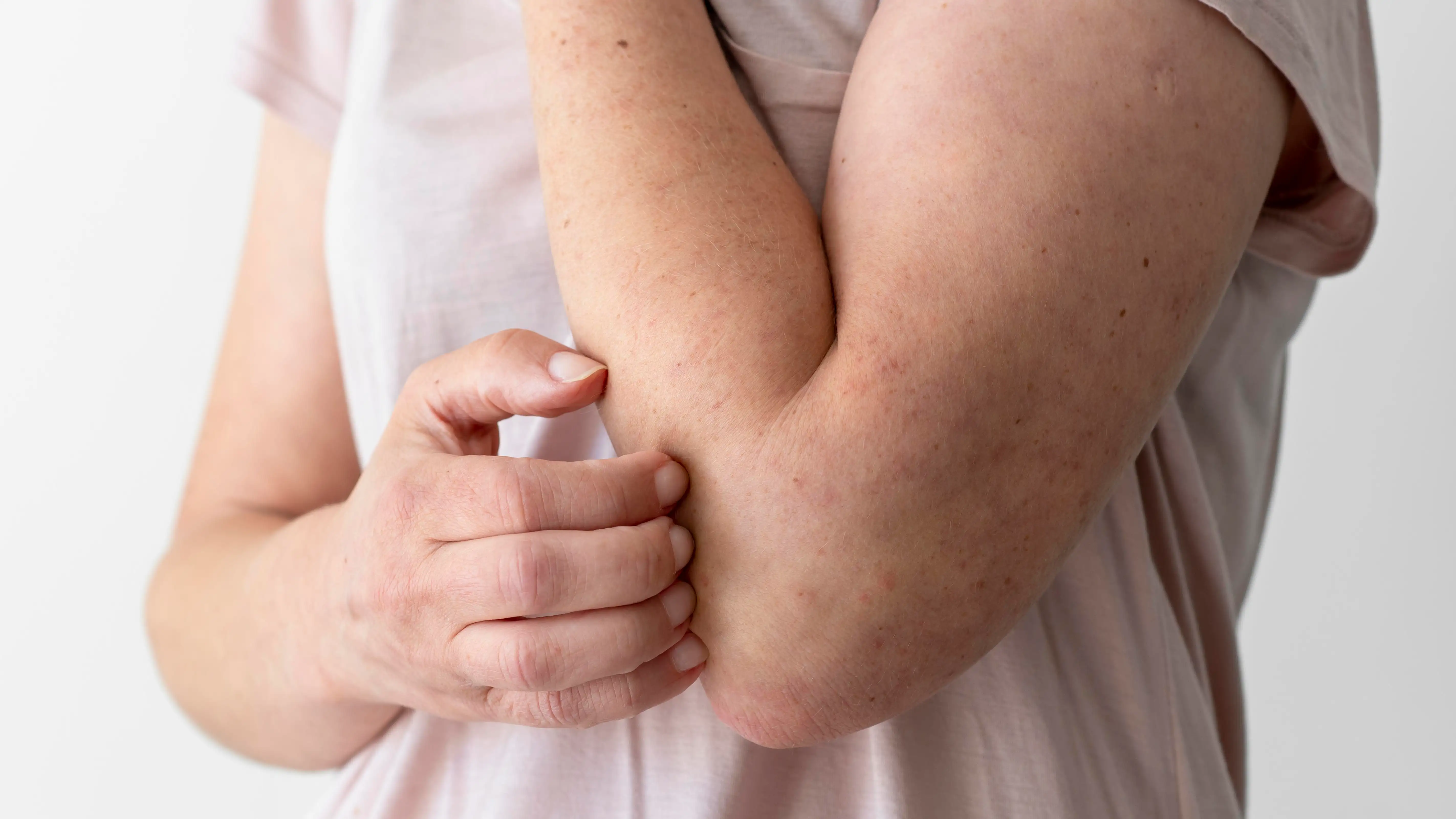 Dermatitis Dermatitis